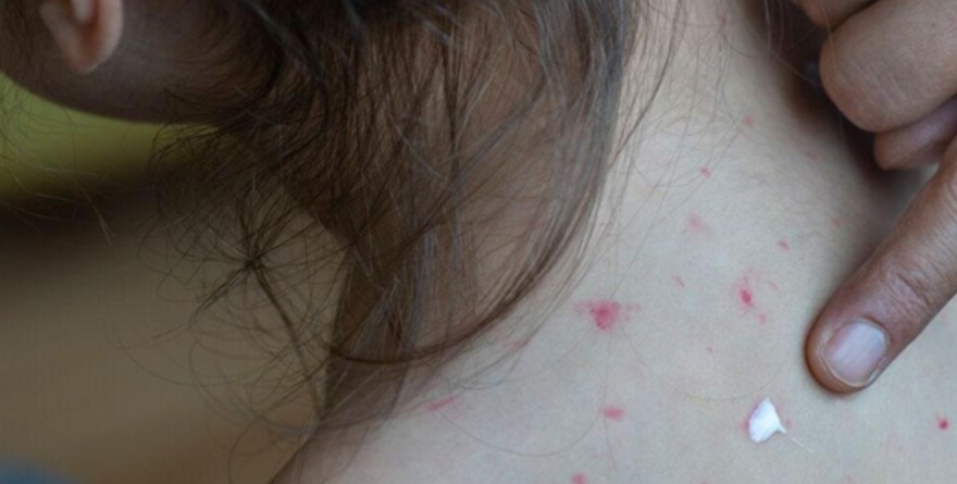 Albergues refuerzan blindaje contra sarampión y gripe