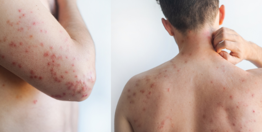 Detectan caso de sarampión importado en la región del Altiplano