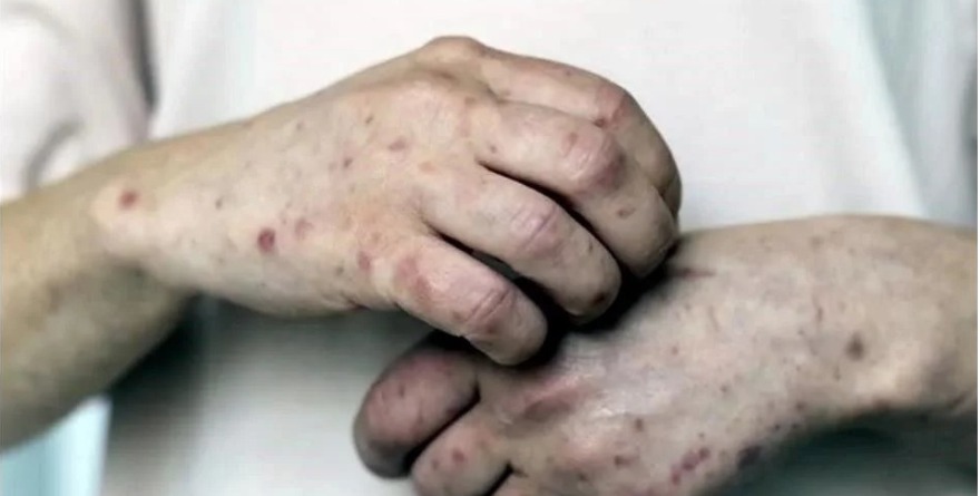 ASEDIA SARAMPIÓN A ADULTOS JÓVENES