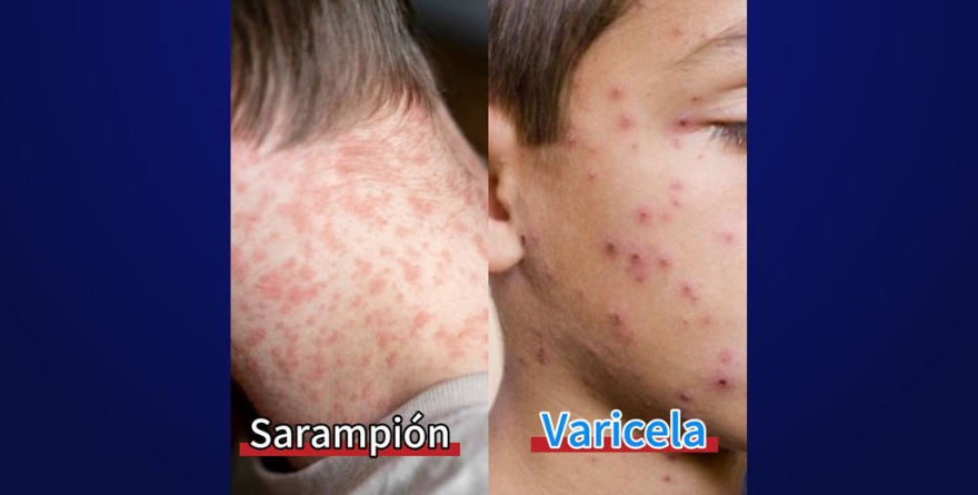 Enseñan a diferenciar sarampión de viruela