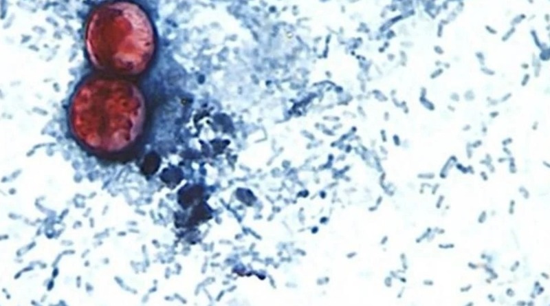 ALERTA GB POR CASOS DE CICLOSPORIASIS